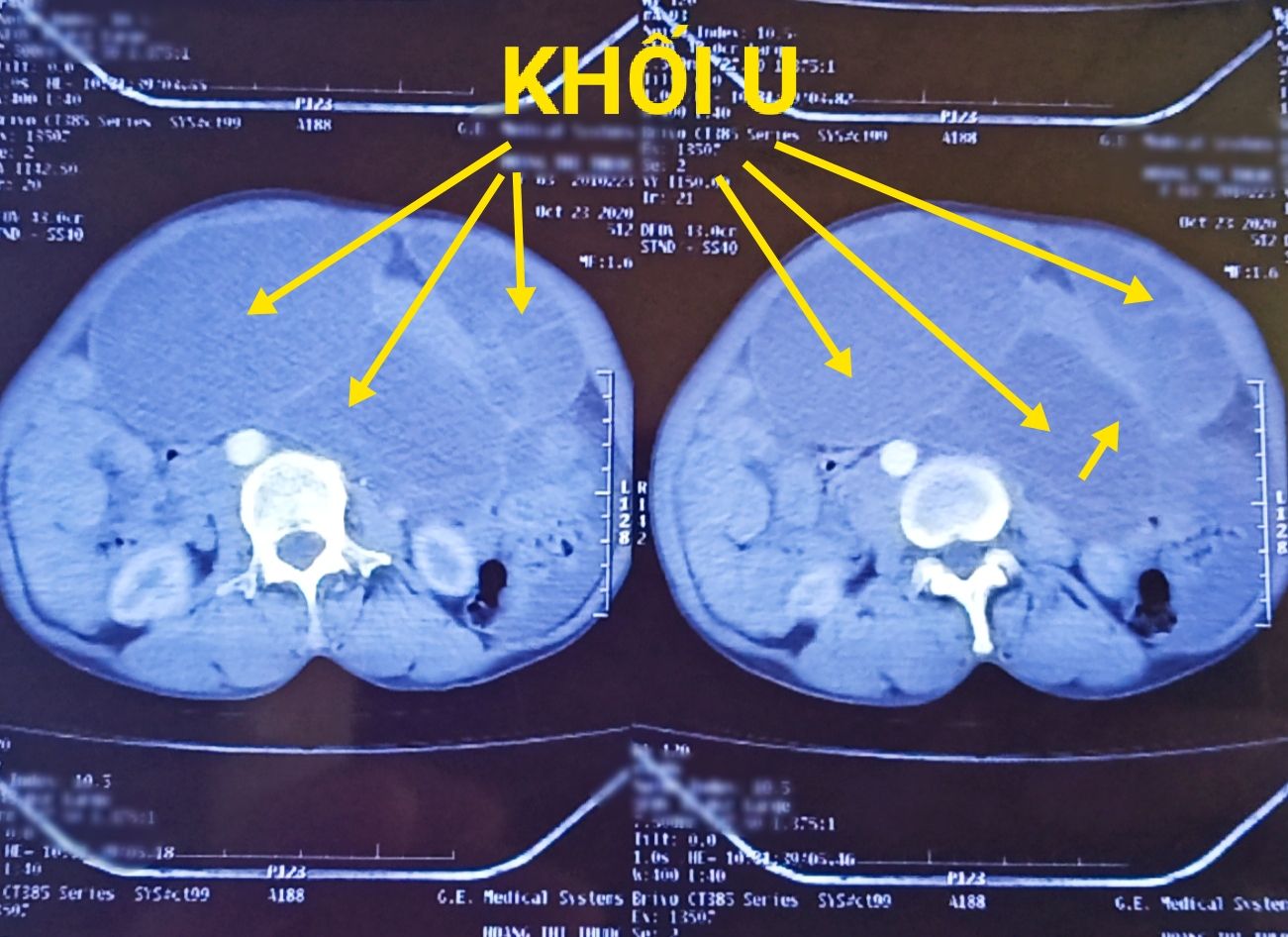 Khối u với nhiều vách ngăn trên hình ảnh Chụp cắt lớp vi tính